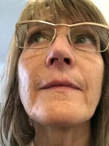 Day 3 Post Peel