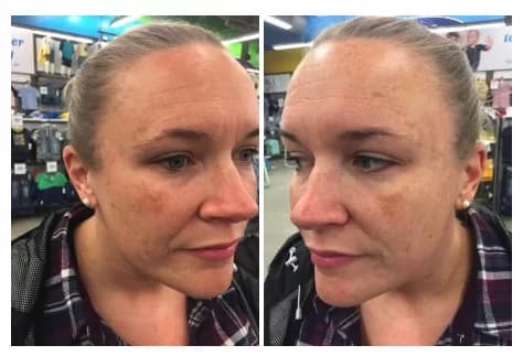 Before: May 2018. Hyperpigmentation, we're coming for you!