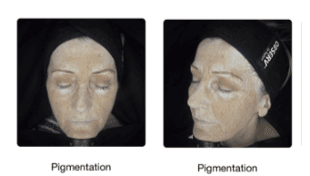 OBSERV pigmentation scan